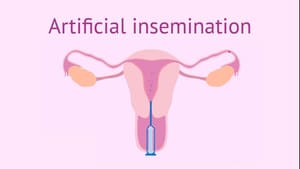 Donor insemination sample vial