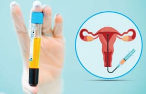 PRP therapy sample and illustration